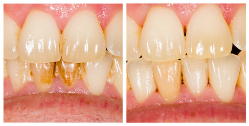 歯の白さの比較画像